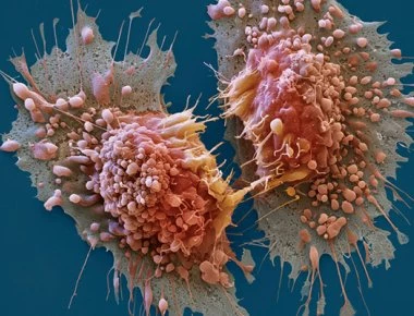 Οι επιστήμονες τον εντόπισαν - Αυτός είναι ο «σούπερ δολοφόνος» όλων των καρκινικών κυττάρων